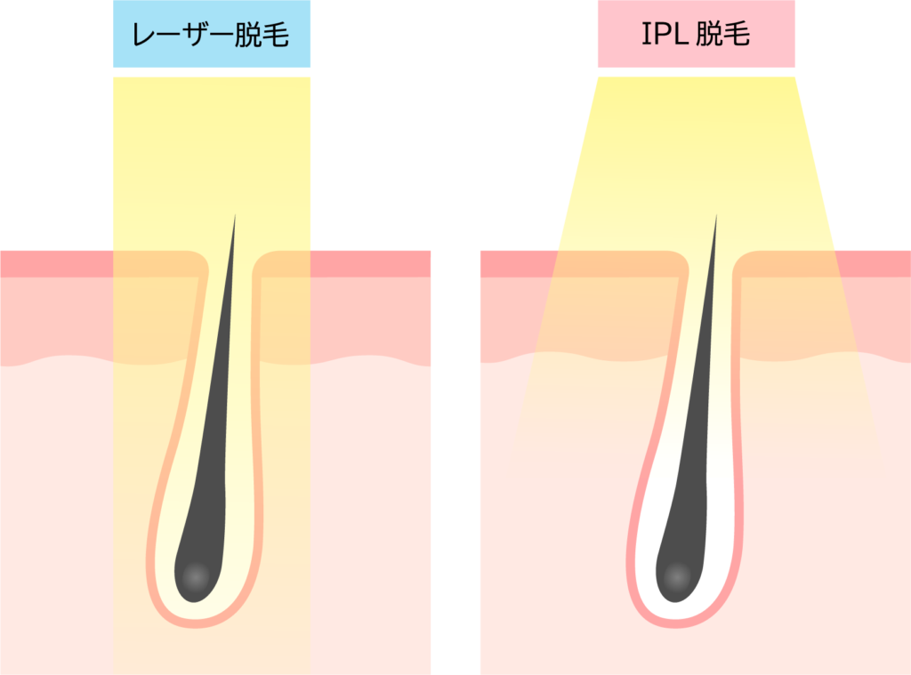 家庭用脱毛器は毎日照射すると効果が高くなる？適切な使用頻度にはきちんと理由があった！